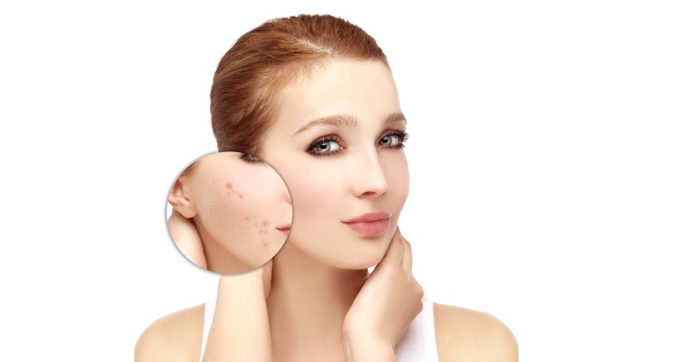 All That You Need to Know About Acne